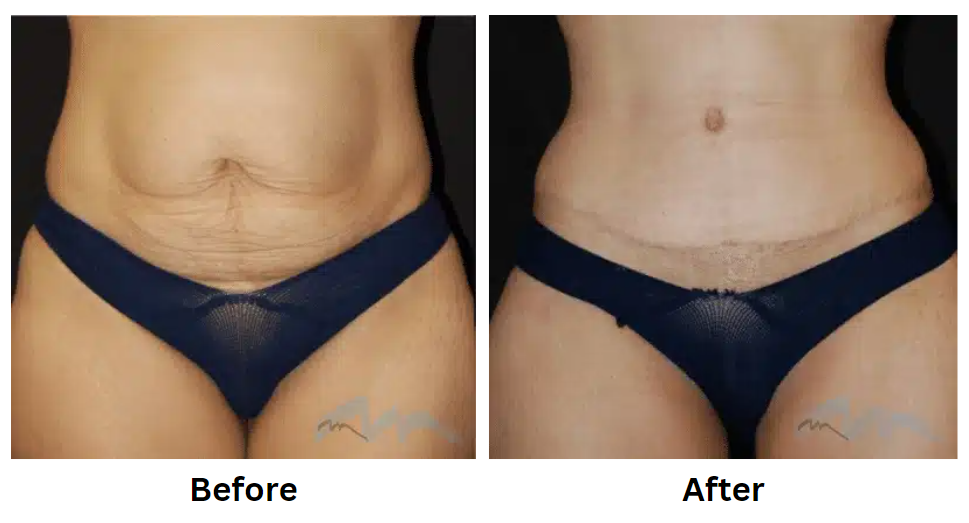 Why Choose Abdominoplasty Surgery in Miami?